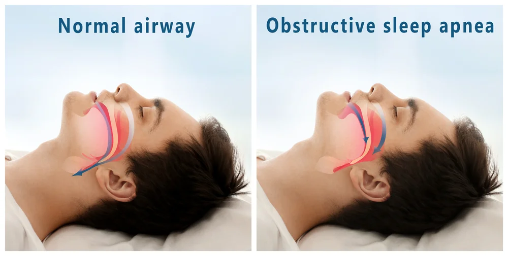 sleep apnea treatments mill valley ca